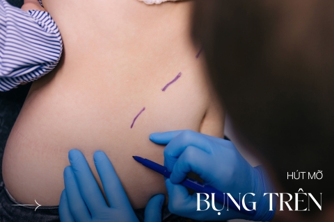 Hút mỡ bụng trên
